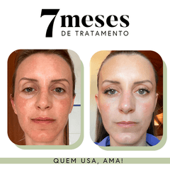 Kit Ritual Essencial - Manchas e Melasma