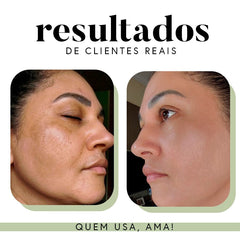 Kit Ritual Essencial - Manchas e Melasma