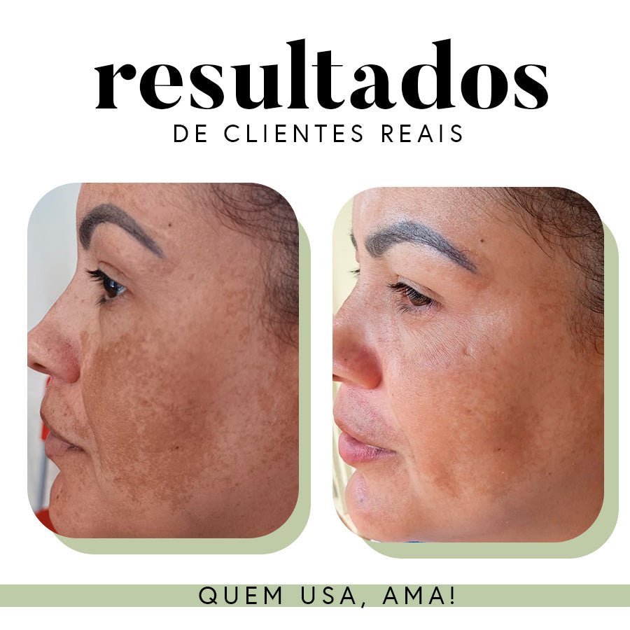 Kit Ritual Essencial - Manchas e Melasma